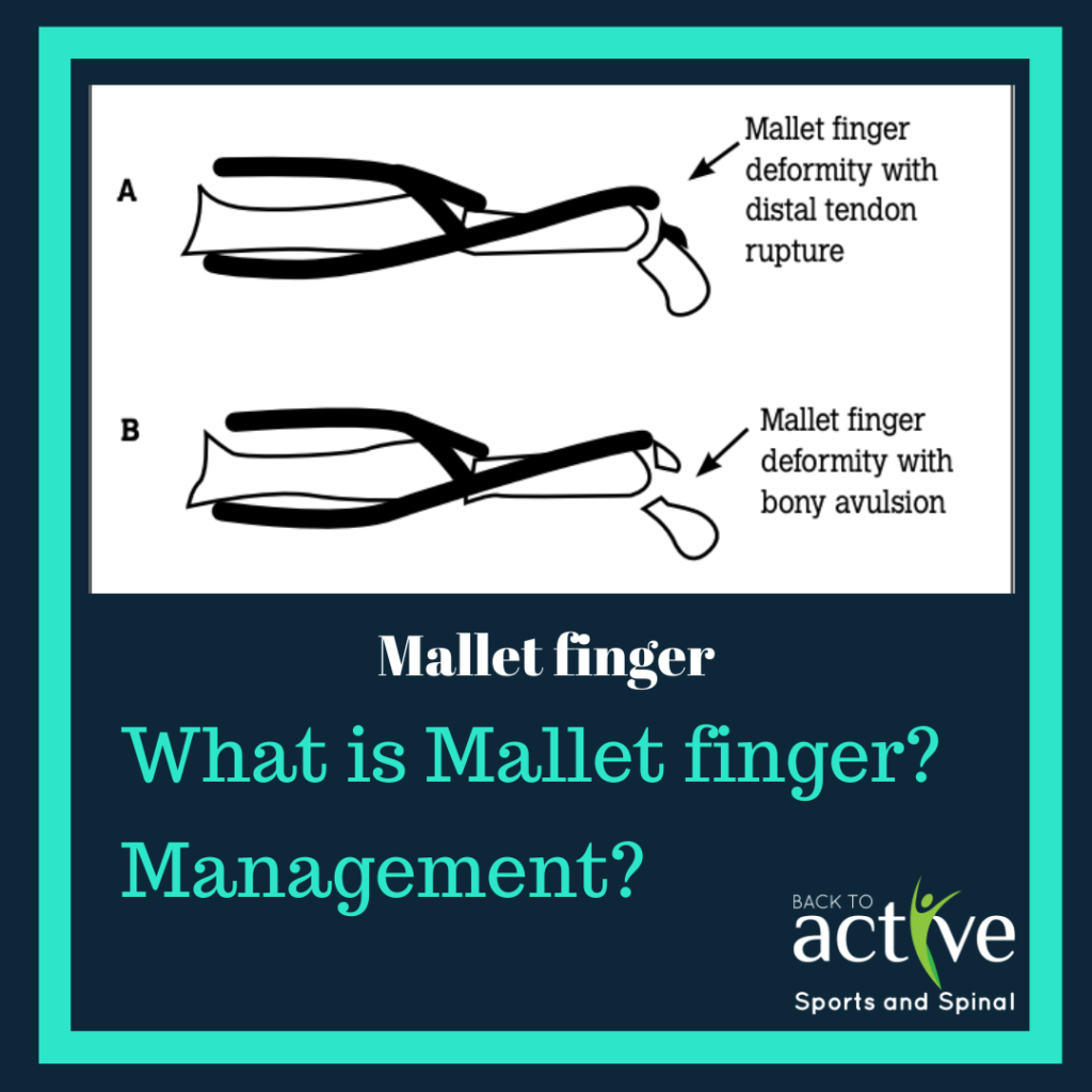 Mallet Finger Back to Active Sports and Spinal Macquarie Park